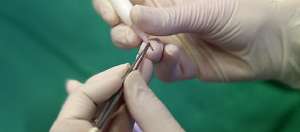 DIRECT HAIR TRANSPLANT