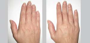 hand rejuvenation