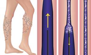 sclerotheraphy