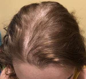 women hair loss