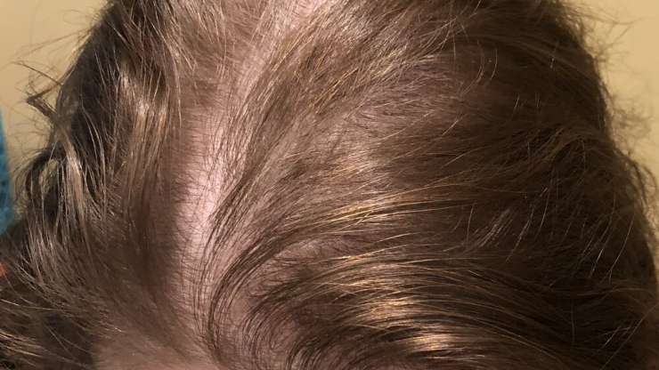 Women Hair Loss